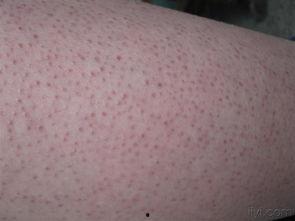 明星去毛周角化,揭秘去毛周角化绝招